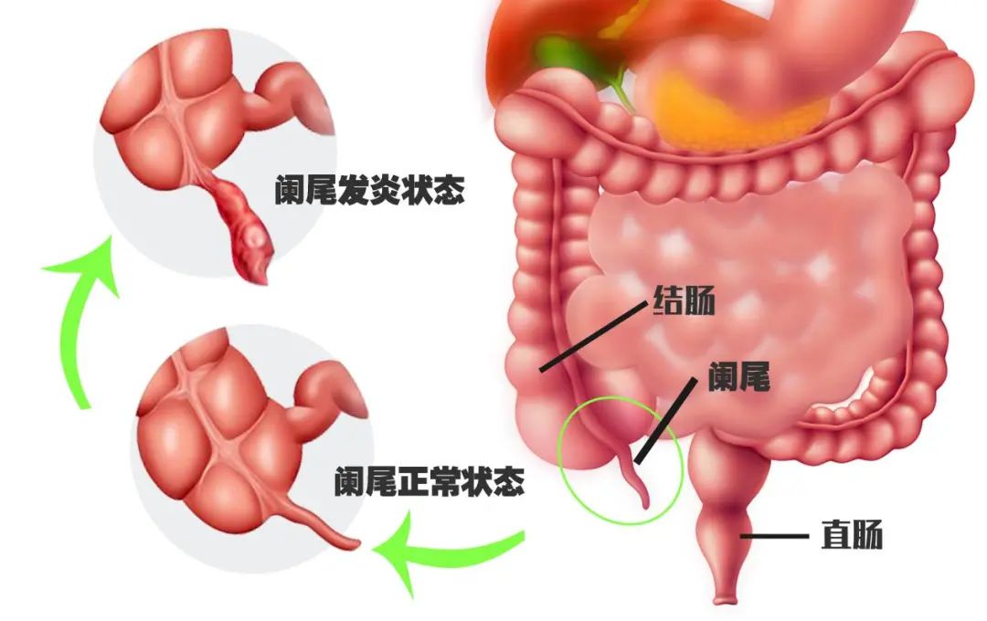 【临床佳音】误把阑尾炎当肠胃炎 入院时恶化为阑尾穿孔